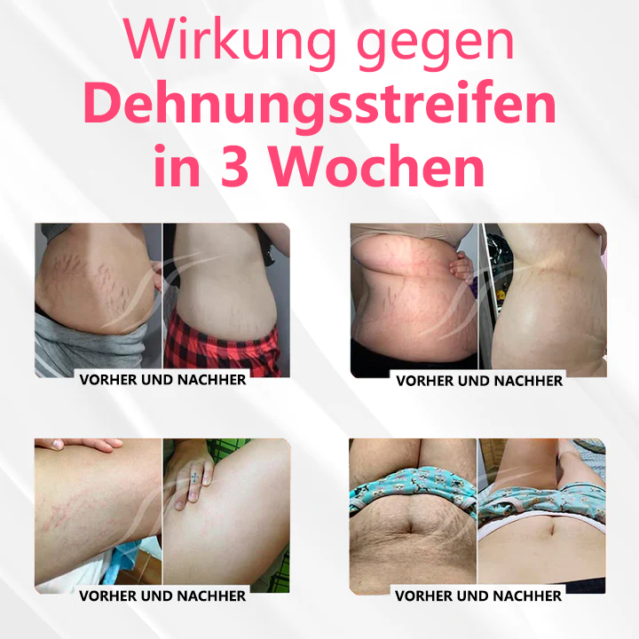 WORDKIN™ Magnetischer Nano-Ionen-Fettverbrennungs-Bauchkontroll-Entgiftungsformer